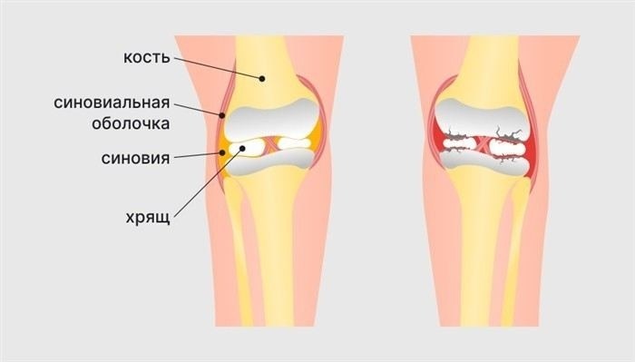 Основные симптомы артроза суставов: на что обратить внимание?