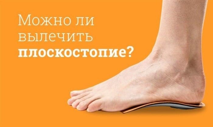 Как правильно проводить профилактику плоскостопия у детей и взрослых