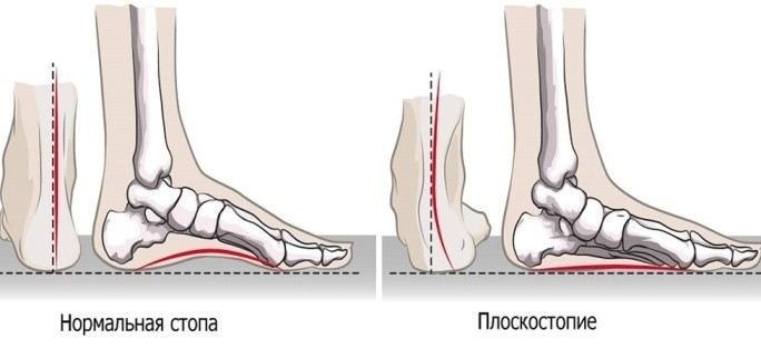 Плоскостопие: диагностика, лечение и профилактика