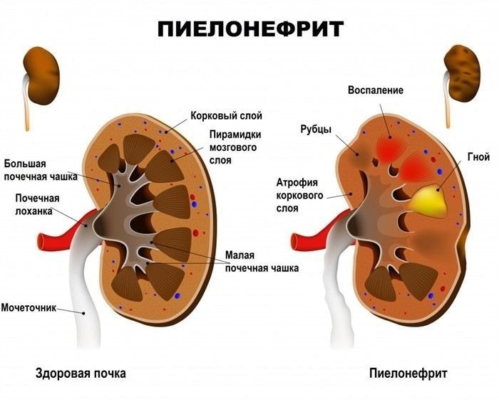 Что провоцирует обострение воспаления почек