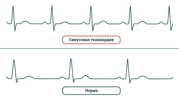 Какие виды нарушений ритма сердца существуют и как они влияют на призыв?