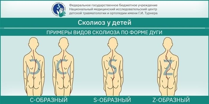 Реабилитация после операции по исправлению сколиоза 4-й степени