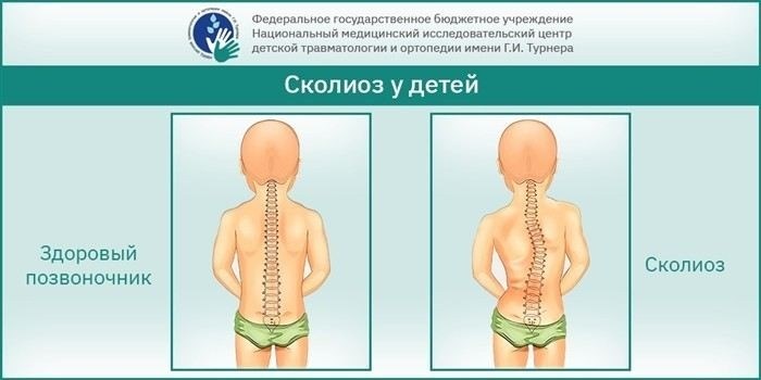 Хирургическое вмешательство при сколиозе 4-й степени: показания и риски