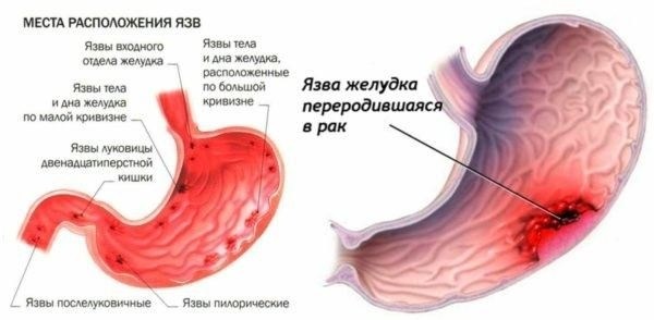 Как язва желудка классифицируется по медицинским показаниям для службы